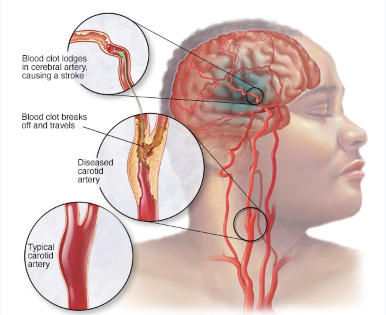 Plaque formation in the carotid artery can lead to stroke (Image from Mayo Clinic)